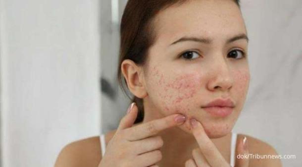 Zinc Bantu Atasi Jerawat, Mitos atau Fakta?