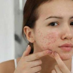 Zinc Bantu Atasi Jerawat, Mitos atau Fakta?